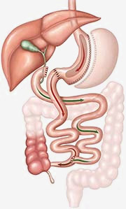 Duodenal Switch