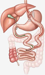 Gastric Bypass